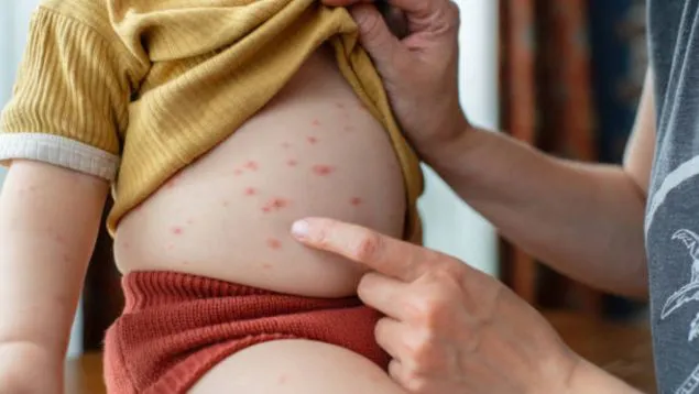 Caso de sarampión en Salta